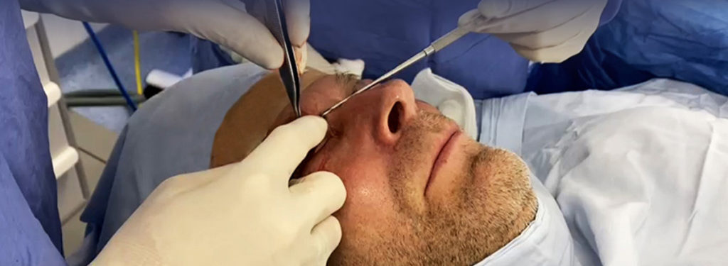 Blefaroplastia: una solución eficaz para tus párpados caídos