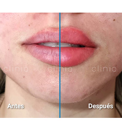 En la imagen se puede observar el antes y el después de unos labios que han sido tratados con ácido hyalurónico para aumentar su tamaño