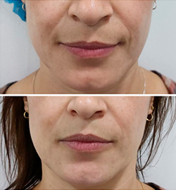 En la imagen se puede observar una paciente que se realizó un tratamiento con ácido hyalurónico e Cliniq. En la foto se puede observar el antes y el después.