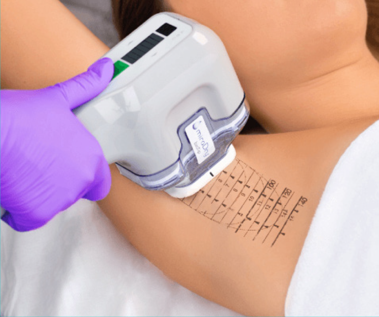 Tratamiento hiperhidrosis axilar - MiraDry